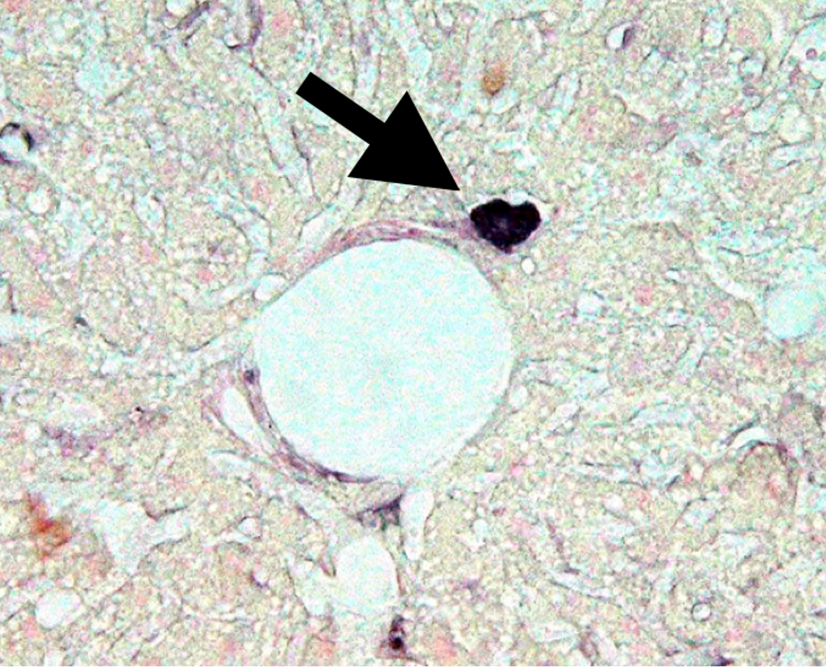 Diabetes Stem Cells: Strange Cells Producing Proinsulin